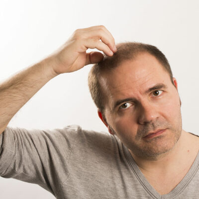 Initial Stages of Male Pattern Baldness