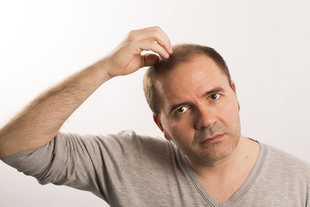 Initial Stages of Male Pattern Baldness