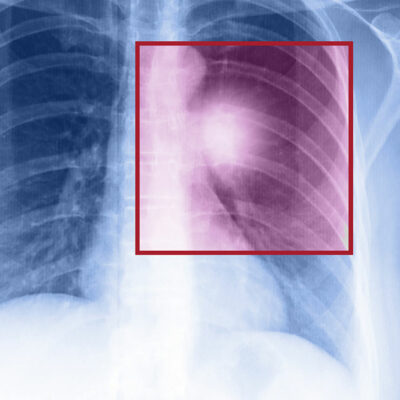 Surgery for Non-Small Cell Lung Cancer