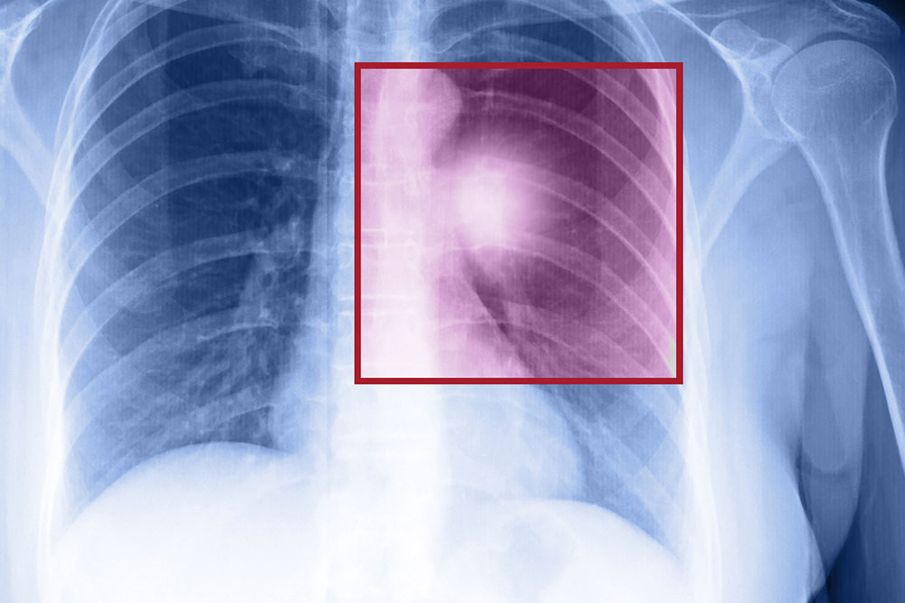 Surgery for Non-Small Cell Lung Cancer