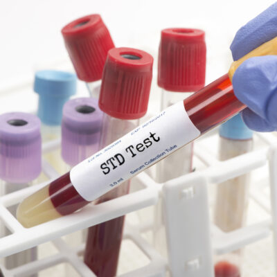 The Benefits of Using an At-Home STD Testing Kit