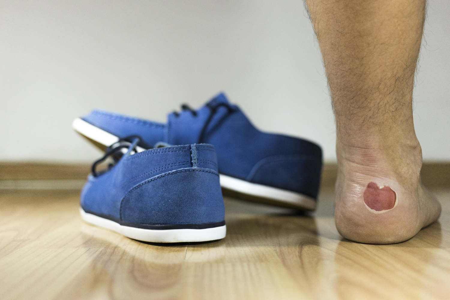 How to Treat and Prevent Blisters