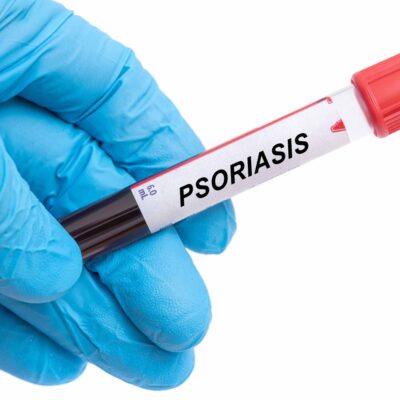 Foods To Avoid For Psoriasis And Treatment Options